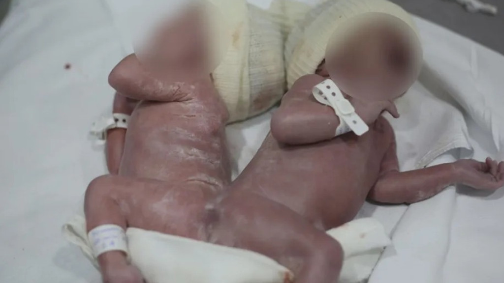 CASO RARO: Gêmeos nascem unidos por osso da coluna