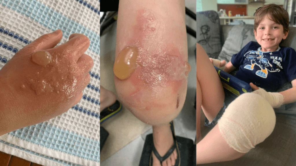 Menino de 7 anos sofre queimaduras após contato com cítricos durante férias