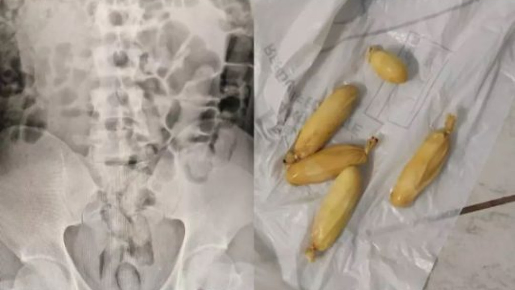 Polícia descobre crime após homem passar por raio-x no estômago em SC
