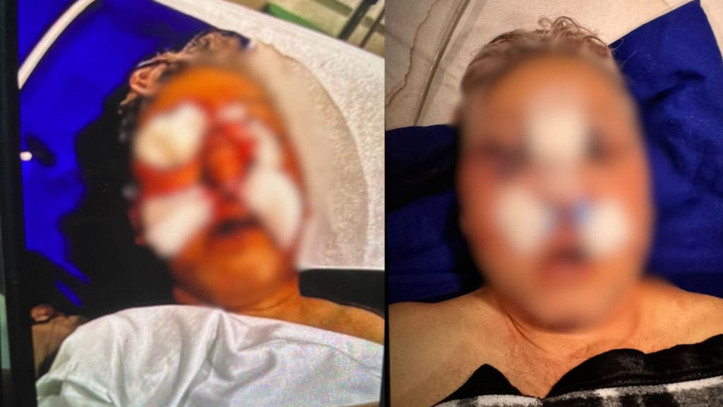 Suposto golpista tem rosto desfigurado após ser espancado em Balneário Camboriú