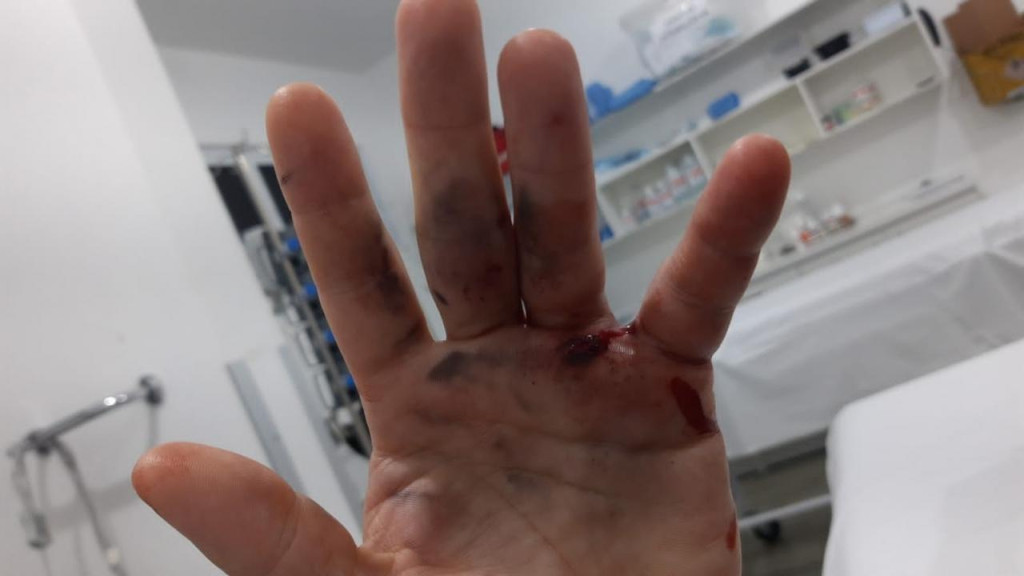 Homem vai parar no hospital após atirar acidentalmente na própria mão em São João Batista