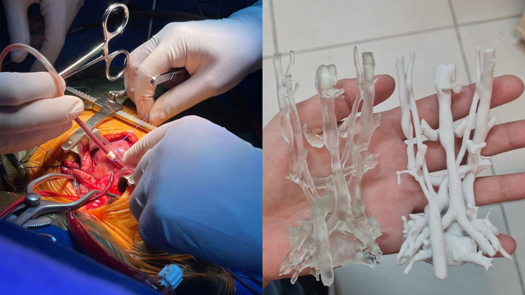 SUS de Santa Catarina realiza cirurgia inovadora em bebê com malformação rara da traqueia