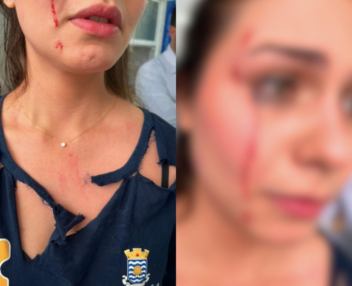 Servidora do CEO ferida após as agressões em Balneário Camboriú