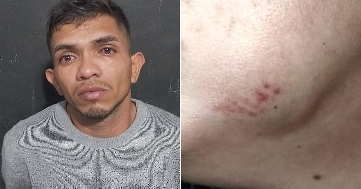 “Vampiro do Pará” é preso depois de morder o rosto da esposa em Navegantes
